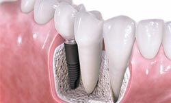 مزایای استفاده از ایمپلنت نسبت به دست دندان متحرک و یا پروتز ثابت چیست پایگاه خبری انجمن دندانپزشکان عمومی ایران